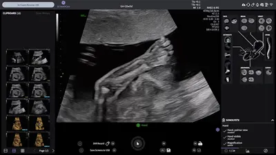 GE HealthCare запускает УЗИ-аппараты Voluson Performance с AI-функциями